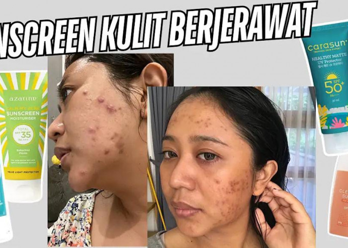 3 Rekomendasi Sunscreen yang Cocok untuk Kulit Berjerawat Terbaik