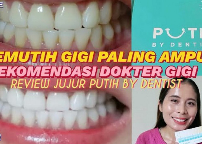 2 Merek Pemutih Gigi terbaik di Indomaret, Ampuh Putihkan Gigi dan Rontokkan Karang Menahun dalam 5 Menit