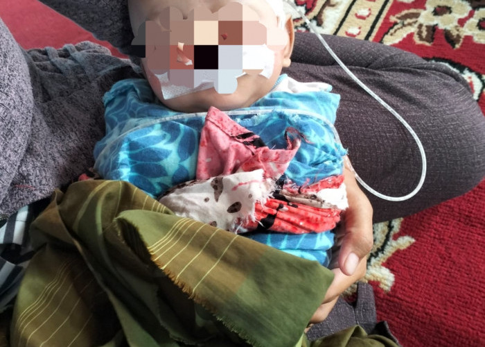Bayi 7 Bulan di Wiradesa Berjuang Lawan Bibir Sumbing, Orang Tua Harapkan Bantuan Pengobatan
