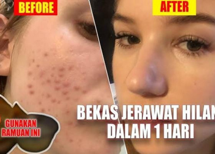 Begini Cara Agar Jerawat Hilang dengan Cepat dalam 1 Hari, Cuma Pakai Bahan Alami Bikin Percaya Diri Lagi