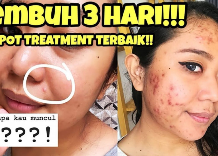 5 Merk Acne Spot Treatment Sesuai Permasalahan Jerawat, dari Bruntusan sampai Noda Hitam Akan Pudar 