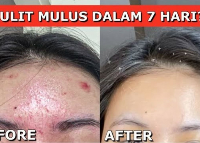 Cara Sembuhkan Jerawat dan Pudarkan Bekasnya Secara Alami, Pakai 1 Bahan Ampuh!