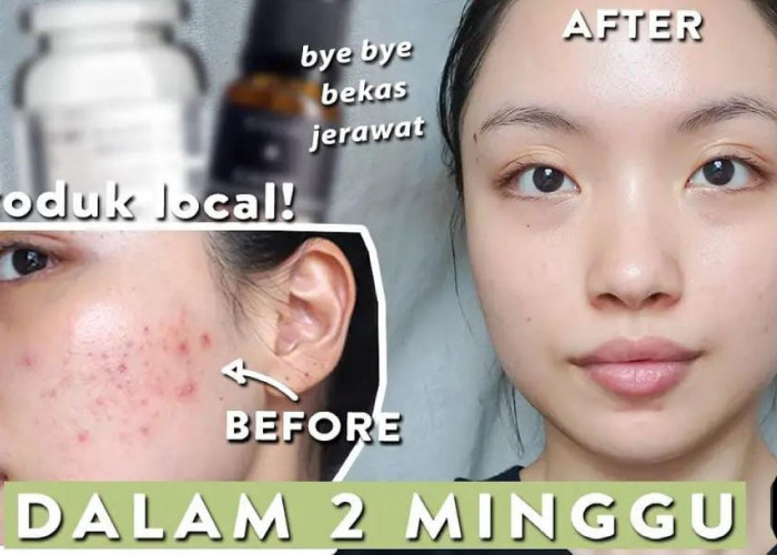 5 Merk Masker untuk Menghilangkan Bekas Jerawat Hitam Dengan Cepat