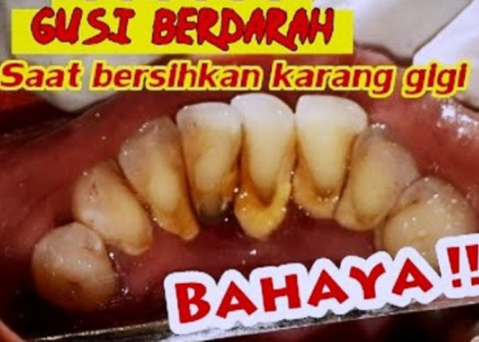 Inilah 3 Bahaya yang Akan Terjadi, Apabila Karang Gigi yang Sudah Mengeras Tidak Segera Dibersihkan, Cek Yuk!