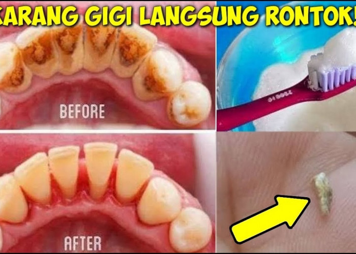 5 Merek Pasta Gigi yang Ampuh Menghilangkan Karang Gigi Membandel dalam 1 Malam, Gigi Putih Maksimal Anti Plak