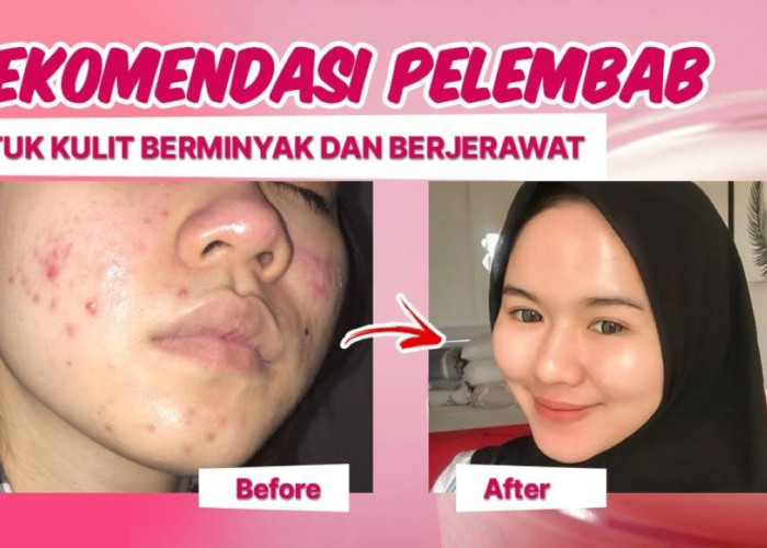 4 Pelembap untuk Kulit Berminyak dan Berjerawat yang Bikin Kulit Tampak Sehat dan Segar 