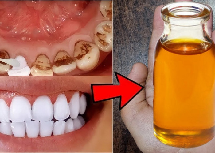 Begini Cara Ampuh Memutihkan Gigi Kuning dan Berkarang dengan Cuka Apel, 5 Langkah Bikin Gigi Putih Lagi