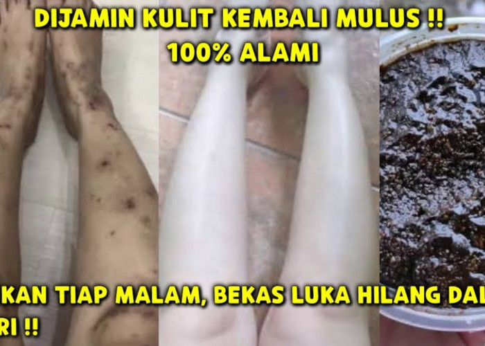 2 Cara Menghilangkan Bekas Luka yang Menghitam dengan Cepat, Cuma Pakai Bahan Dapur!