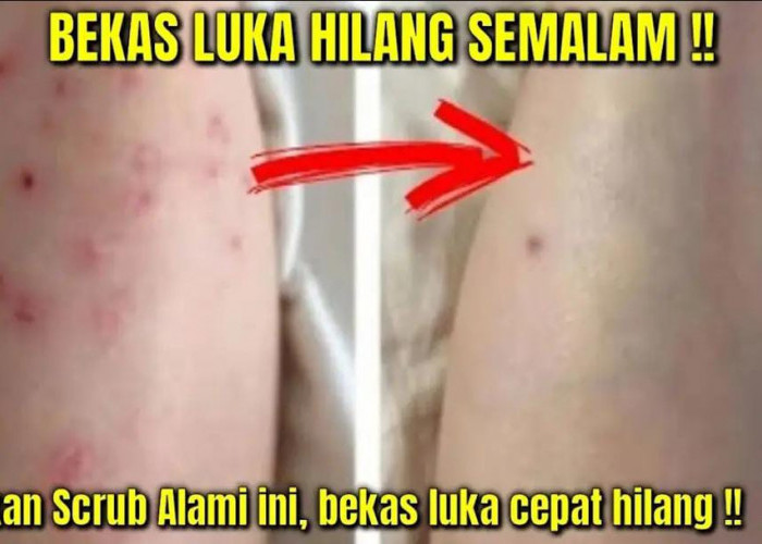 3 Cara Meracik Penghilang Bekas Koreng Hitam yang Sudah Lama, Cuma Pakai Bahan Dapur Kulit Mulus dan Putih