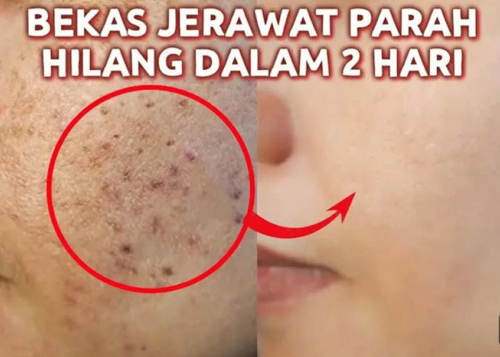 Masker Penghilang Bekas Jerawat Hitam di Wajah, Begini 3 Langkah Membuatnya Cuma Pakai Bahan Alami