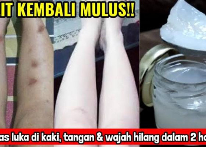 Begini 5 Cara Menghilangkan Bekas Luka Menghitam di Kulit Secara Permanen dengan Cepat Pakai Bahan Alami