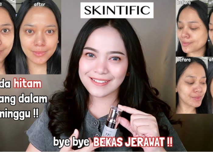 Cara Mengatasi Flek Hitam dengan Mudah, Cukup Gunakan 4 Skincare Ini Saja