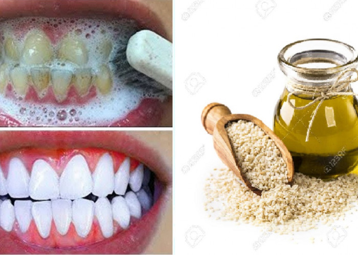 4 Cara Instan Membersihkan Karang Gigi yang Sudah Mengeras dengan Bahan Alami, Auto Plak Rontok dalam Semalam