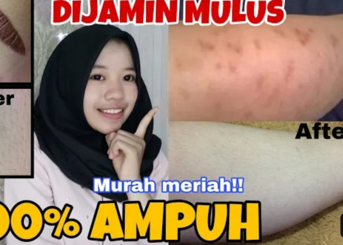 4 Cara Menghilangkan Koreng di Kaki Dengan Cepat Menggunakan Bahan Alami, Bekas Luka Hitam jadi Putih Permanen