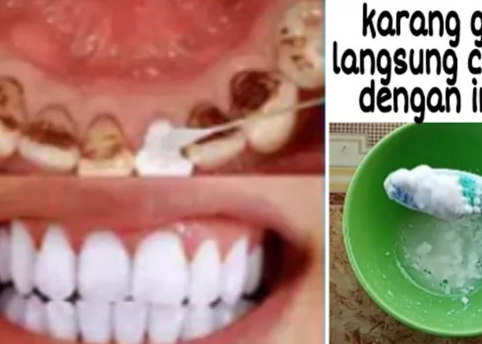 3 Cara Membersihkan Karang Gigi yang Sudah Mengeras Secara Alami Dalam 1 Kali Pakai, Ampuh Putihkan Gigi