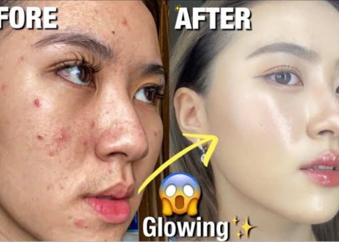 4 Rekomendasi Tinted Sunscreen untuk Kulit Berjerawat, Bikin Wajah Glowing Terlindungi Seharian