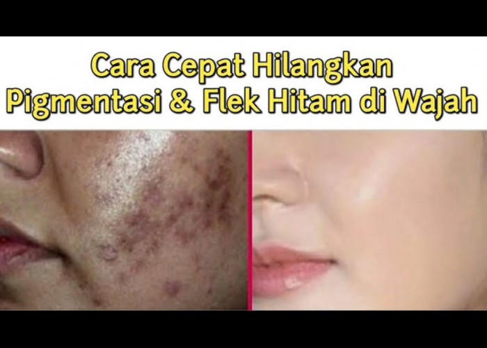 Cara Supaya Flek Hitam Hilang Permanen Dengan Mudah! Cuma Pakai 1 Jenis Buah Wajah jadi Glowing