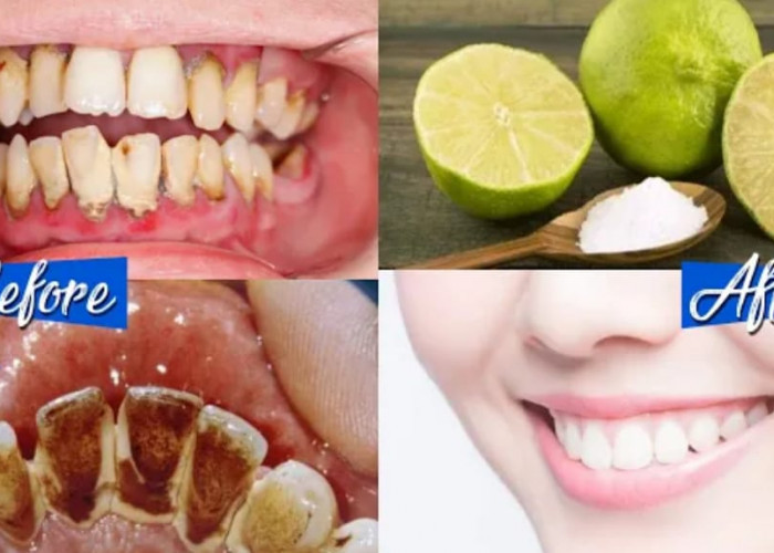 Tanpa Scalling! Ini 4 Cara Cepat Membersihkan Karang Gigi yang Sudah Mengeras Secara Alami, Bikin Gigi Putih
