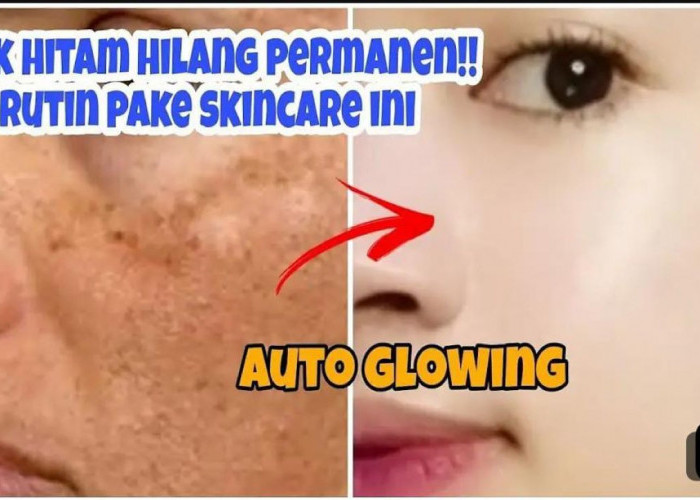 3 Metode Mengelupas Flek Hitam di Wajah Secara Instan Tanpa Pakai Skincare Mahal