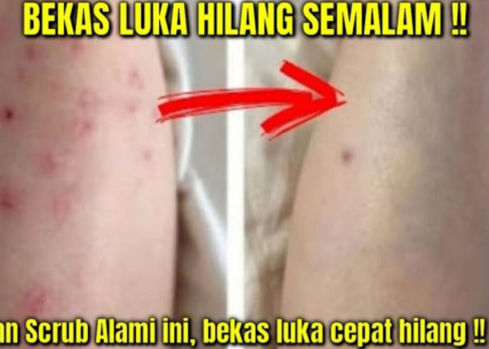 4 Cara Menghilangkan Bekas Luka Hitam di Kaki Secara Alami dan Hasilnya Putih Permanen, Kulit Bebas Noda Hitam