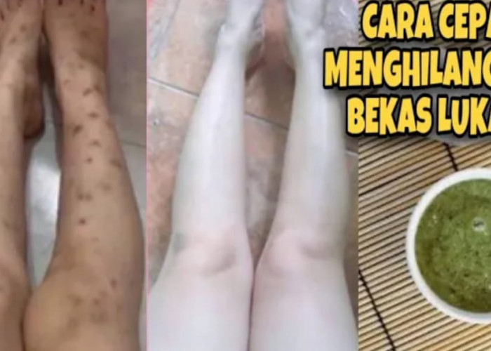 2 Cara Menghilangkan Koreng di Kaki yang Menghitam secara Alami dan Permanen, Kulit Kenyal Putih Bebas Noda