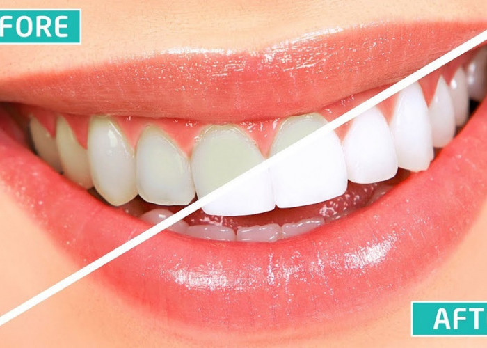 5 Merek Pasta Gigi yang Bisa Memutihkan Gigi Secara Instan dan Permanen dalam 1 Malam Bebas Plak dan Karang