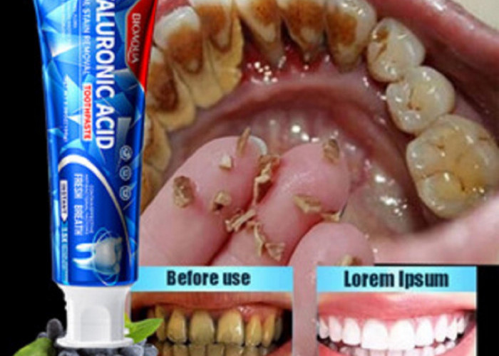 Inilah 5 Rekomendasi Obat untuk Membersihkan Karang Gigi Paling Ampuh di Apotik, Dijamin Efektif