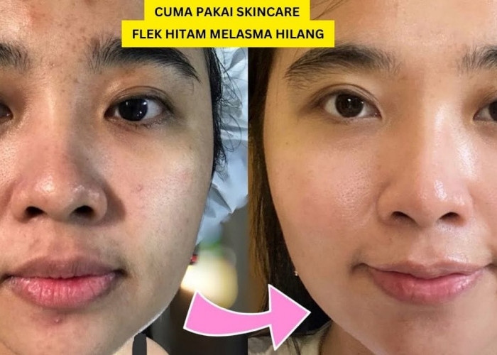 Ini Dia 5 Skincare Terbaik untuk Menghilangkan Flek Hitam Melasma, Bikin Wajah Glowing Putih Bebas Noda