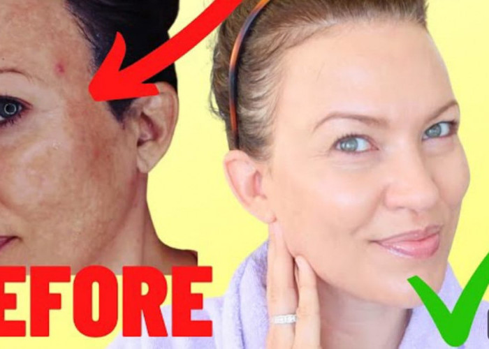 Ternyata, Ini 4 Skincare untuk Menghilangkan Melasma pada Wajah Terbaik! Bikin Awet Muda dan Putih Merata