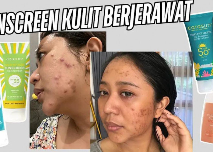 3 Pilihan Sunscreen yang Cocok untuk Kulit Berjerawat dan Kulit Sensitif! Aman Tidak Bikin Lengket