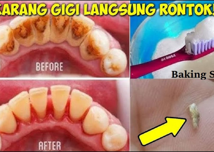 Gak Nyaman Sama Gigi Kuning? Begini 5 Cara Merontokkan Karang Gigi Tebal Secara Efektif dan Cepat