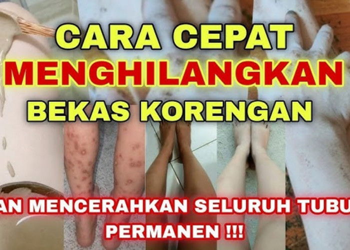 DIY Obat Penghilang Bekas Luka Koreng yang Menghitam, Cuma Pakai 1 Bahan Ini!