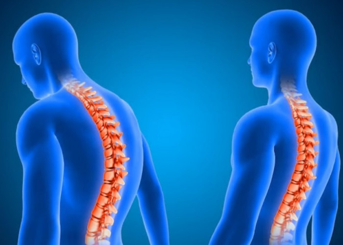 Tubuh Mulai Bungkuk, Ini Dia 6 Gejala Sakit Osteoporosis pada Lansia Usia 50 tahun ke Atas