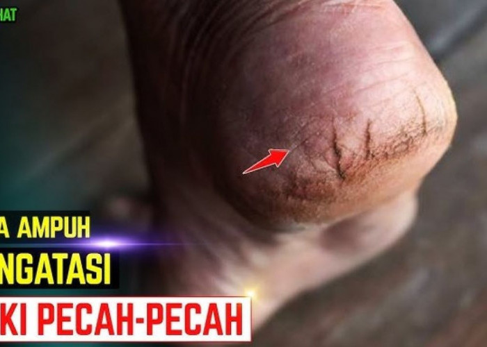 Cara Menghaluskan Tumit Kaki Pecah-Pecah, Pakai 2 Bahan yang Mudah Ditemukan di Pekalongan