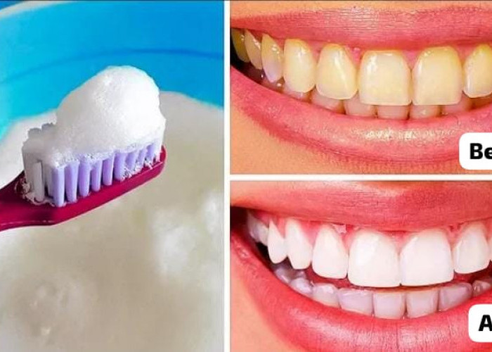 4 Penyebab Gigi Kuning dan Cara Ampuh Mengatasinya, Pakai 1 Bahan untuk Memutihkan Gigi dengan Cepat