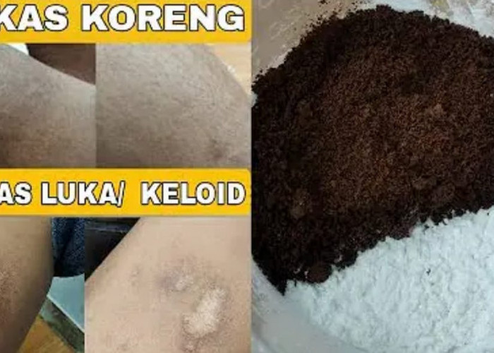 3 Cara Menghilangkan Bekas Luka Bakar yang Menghitam Dalam 1 Malam, Pakai Bahan Dapur Kulit langsung Mulus