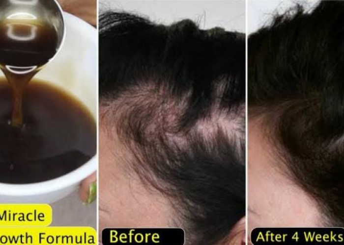 3 Bahan Dapur untuk Menumbuhkan Rambut Botak dan Rontok, Begini Cara Pakainya Agar Rambut Lebat dan Tebal Lagi