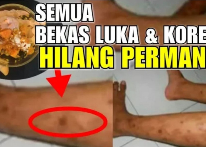 3 Cara Menghilangkan Bekas Hitam di Kaki Secara Alami Dalam Semalam, Cuma 1 Bahan Dapur Kulit Putih Bebas Noda