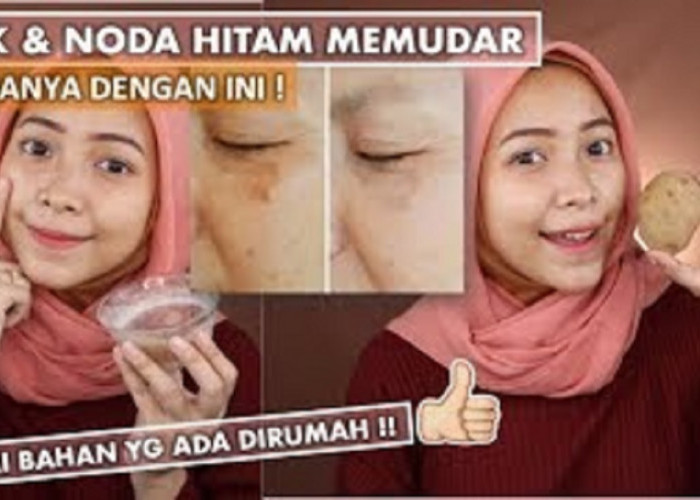 4 Cara Alami Menghilangkan Flek Hitam Di Pipi dengan Cepat Dalam 1 Hari, Intip Cara Ini untuk Wajah Mulus