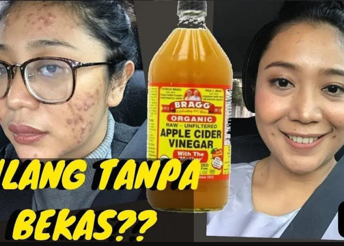 3 Cara Pakai Cuka Apel untuk Menghilangkan Flek Hitam Membandel, Bikin Wajah Glowing