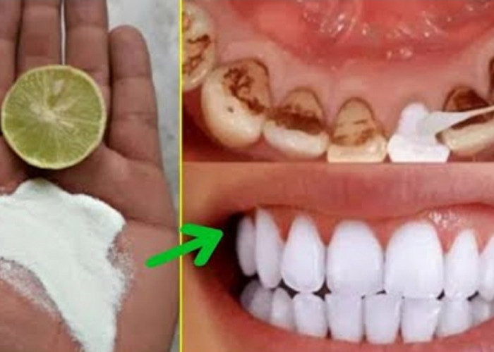 Inilah 7 Cara Sederhana Membersihkan Karang Gigi yang Sudah Menebal dengan Bahan Dapur, Efektif Putihkan Gigi