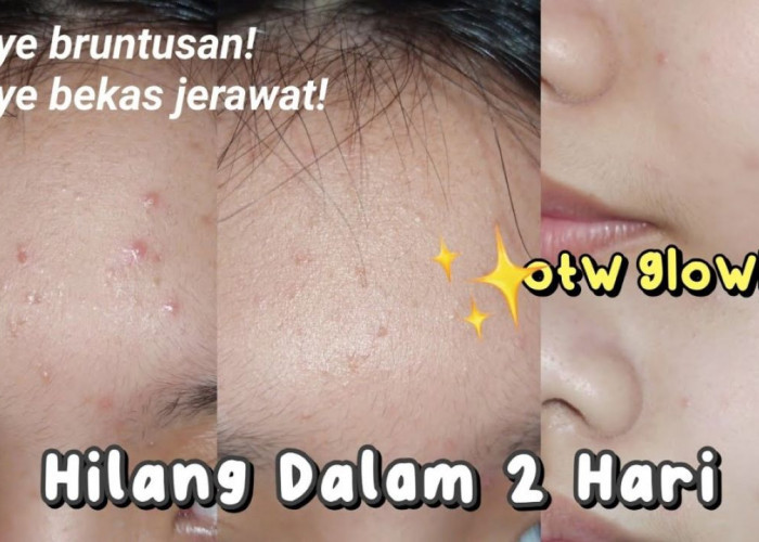 6 Kandungan Skincare yang Bagus untuk Perawatan Kulit Bruntusan, Apa Saja?