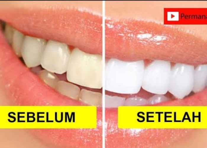 5 Pasta Gigi untuk Memutihkan Gigi di Indomaret Paling Ampuh, Aman dan Terdaftar Bpom