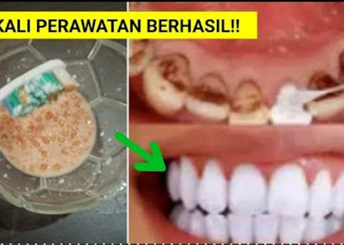 Begini Cara Memutihkan Gigi Kuning dengan Garam dan Odol, 4 Langkah Bikin Karang Gigi Rontok