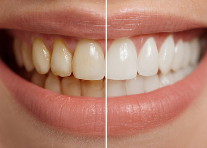 Inilah Cara Memutihkan Gigi yang Kuning dan Berkarang dengan Bahan Alami dalam 3 Hari