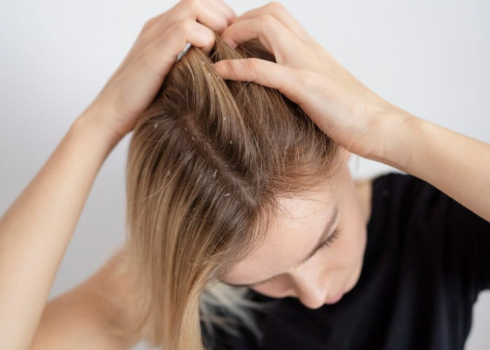 4 Cara Mengatasi Rambut Rontok Parah Hampir Botak Secara Alami