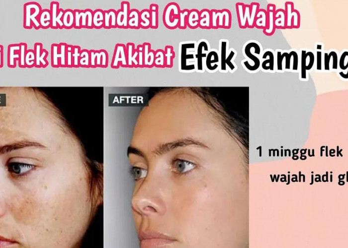 3 Krim yang Bisa Menghilangkan Flek Hitam Agar Wajah Glowing, Cocok Untuk Hilangkan Kerutan di Wajah!