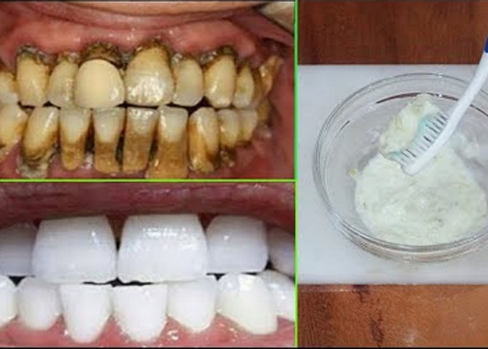 5 Cara Alami Merontokan Karang Gigi yang Sudah Mengeras dan Menebal, Ampuh Putihkan Gigi Tanpa Plak Kuning