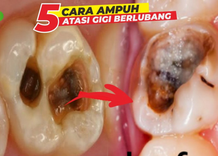 Begini Cara Menghilangkan Gigi Berlubang agar Tidak Kambuh Lagi, Sakit Gigi Hilang Seketika