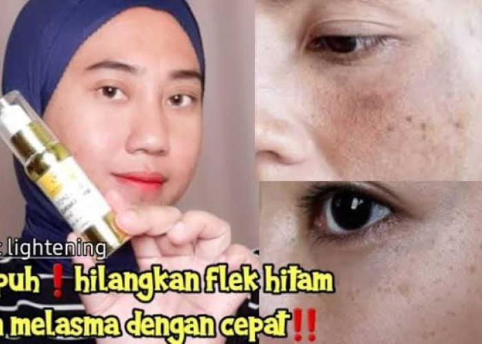 4 Serum untuk Mengatasi Flek Hitam, Bantu Cerahkan Wajah Tepis Noda Hitam dan Kulit Kusam